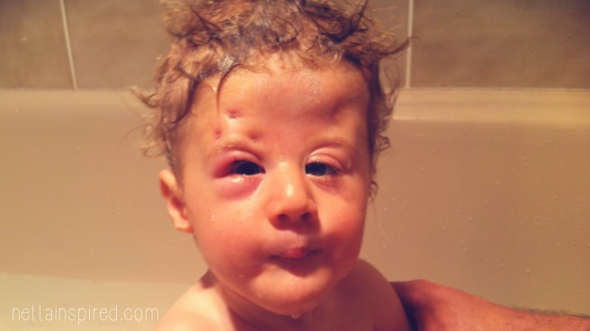 A little swollen after day surgery to insert a silicon sling above his eye. You can see the little anchor point dimples