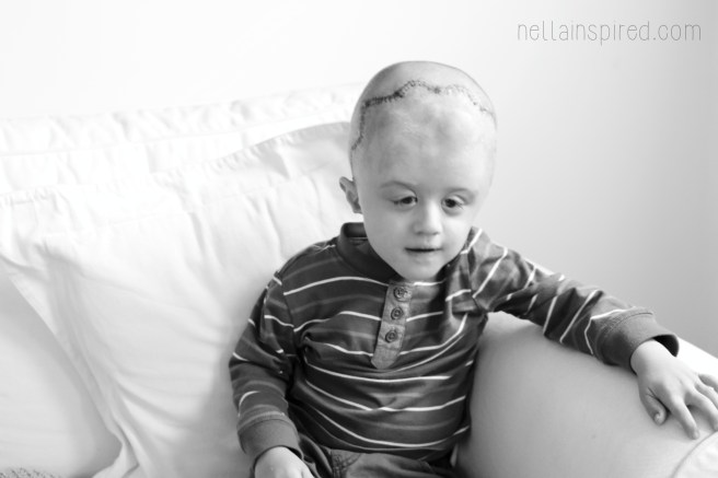 One week post surgery, our little cranio warrior
